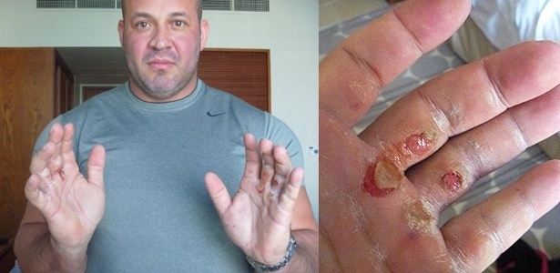Brasileiro Nort exibe as mãos castigadas após participação no Mundial de strongman - Arquivo pessoal