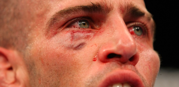 Detalhe do rosto castigado de Assunção na derrota para Ross Pearson no UFC 141